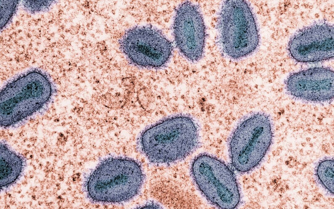 What To Know About MPox, Treatments & What To Do If Infected